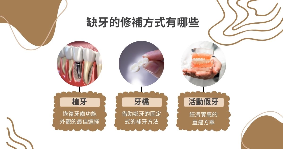 缺牙修補方式有植牙、牙橋、活動假牙