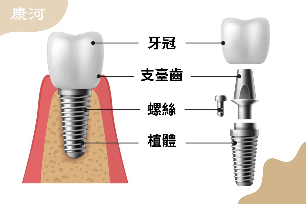 植牙零件有植體、螺絲、支臺齒、牙冠